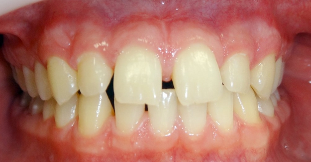 Клинический случай Смещение центральной линии на нижней челюсти влево на 2 мм. Диастема, тремы.