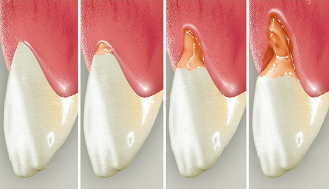Открытые шейки зубов. Симптомы, причины и лечение