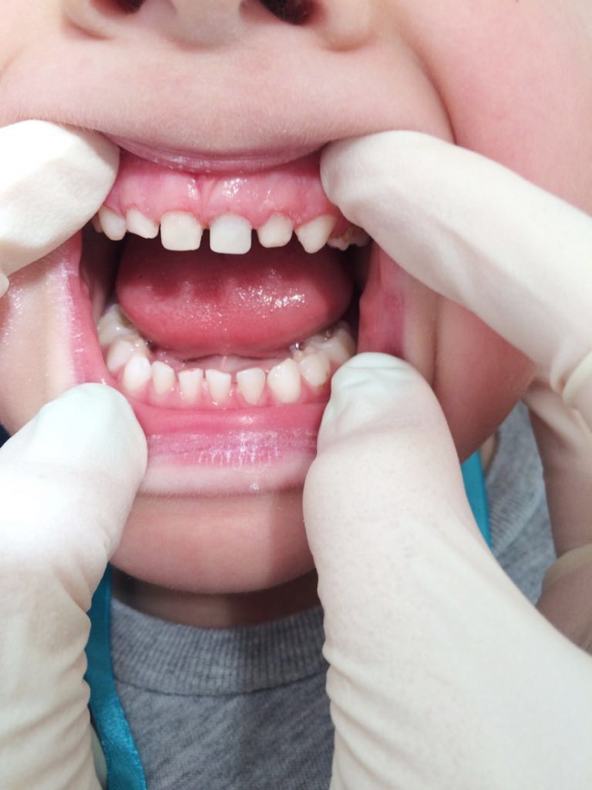 Серебрение зубов у детей, достоинства и недостатки