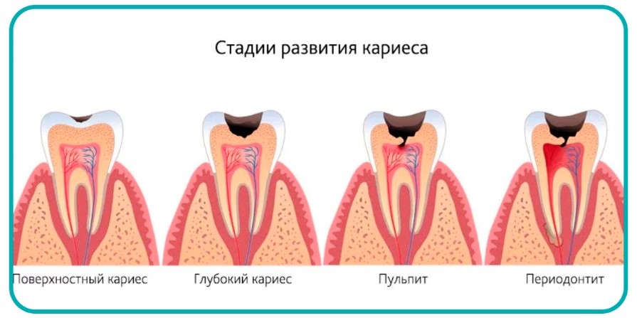 Осложнение лечения периодонтита. Кариес пульпит периодонтит. Пульпит и периодонтит отличия. 4 Канальный пульпит зуба. Зубы кариес пульпит периодонтит.