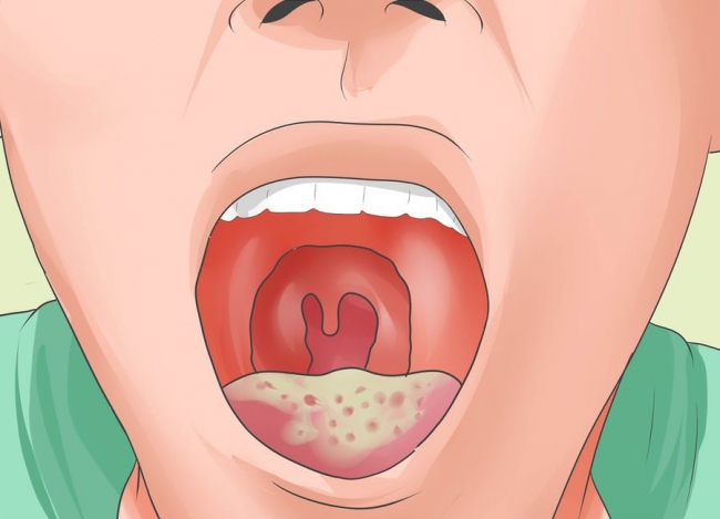 Что необходимо делать при молочнице полости рта