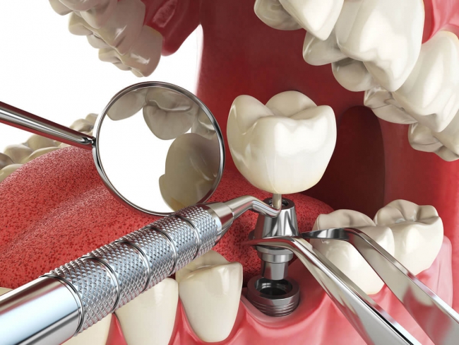 Имплантация зубов: преимущества, недостатки, риски