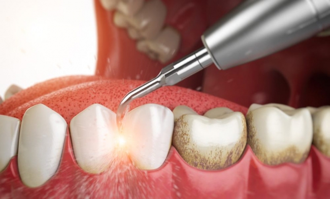 Как избавиться от зубного камня: 5 простых способов