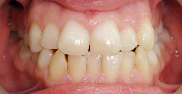 Клинический случай Смещение центральной линии на нижней челюсти влево на 4 мм. Скученность зубов.