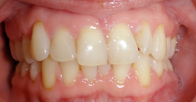 Клинический случай Смещение центральной линии на верхней челюсти влево. Скученность зубов. Стираемость режущих краев нижних резцов.