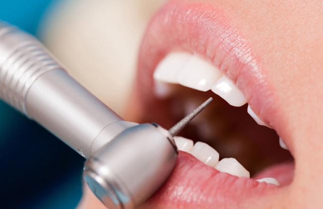 Кариес зубов: симптомы, стадии, способы лечения