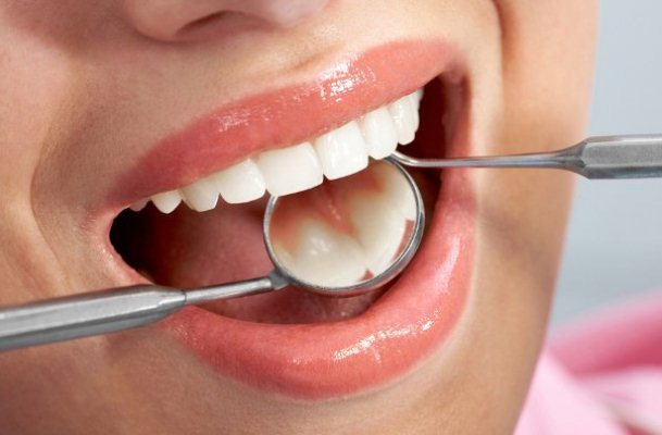  Лечение "нерва" зуба - пульпита