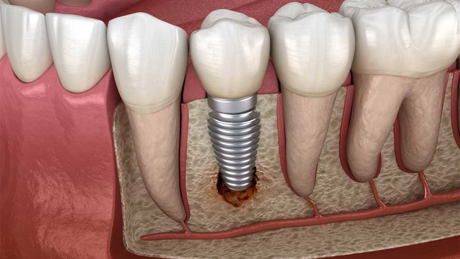 Причины отторжения импланта зуба